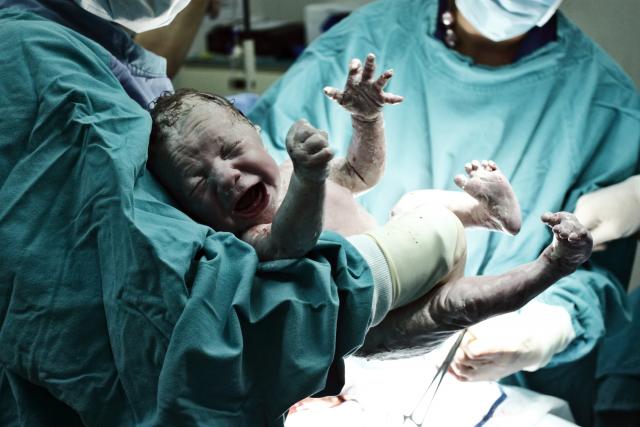 Beba roðena "trudna": Redak medicinski fenomen u Indiji